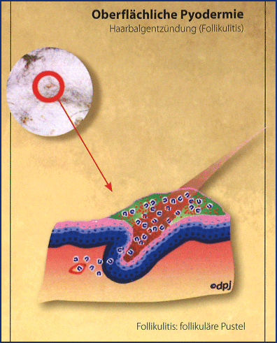 OP-Follikulitis.png