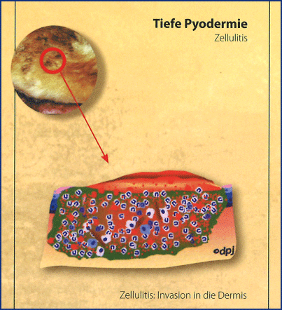 TP-Zellulitis.png